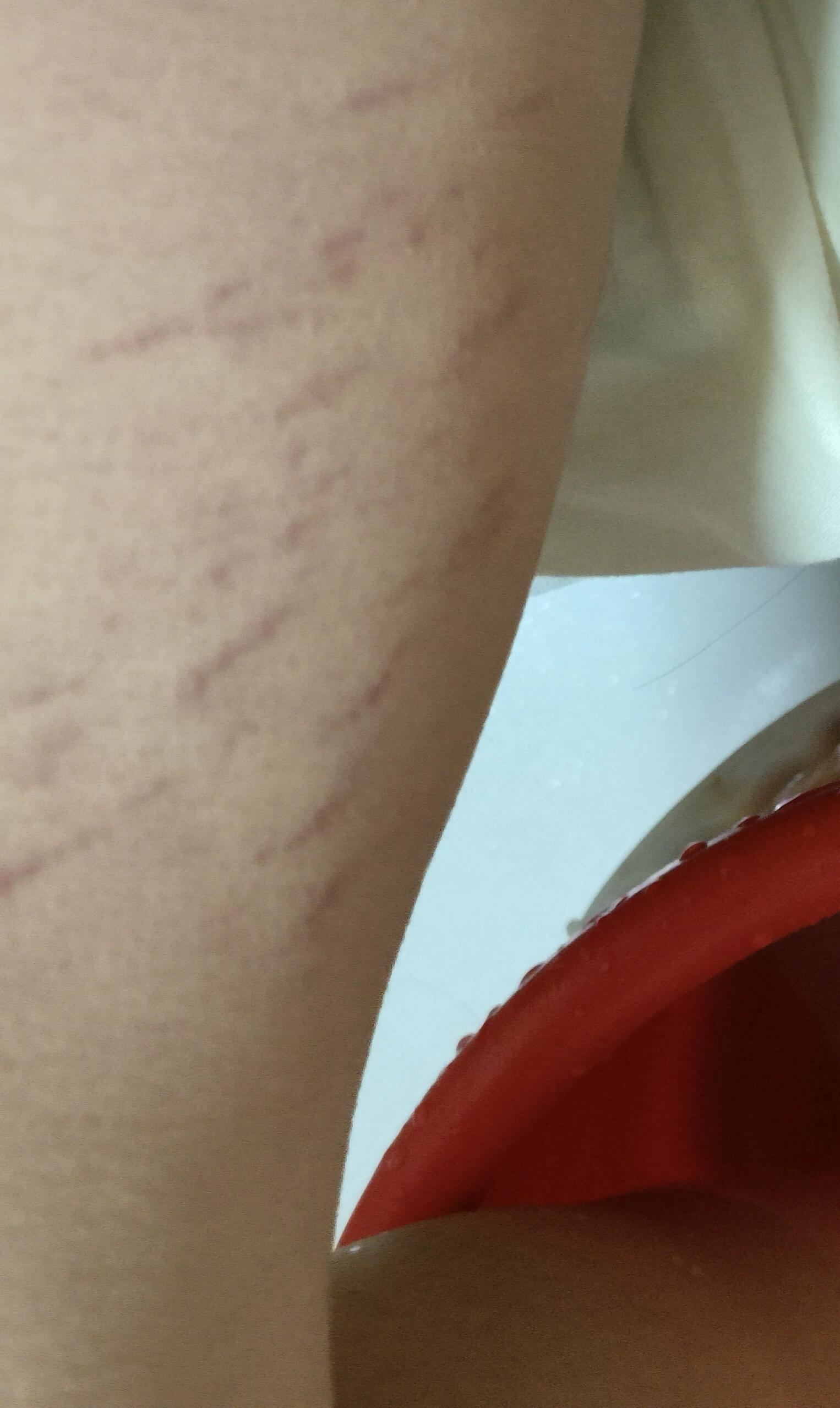 这种是肥胖纹吗? 有没有姐妹有同样的纹呀  大腿内侧的