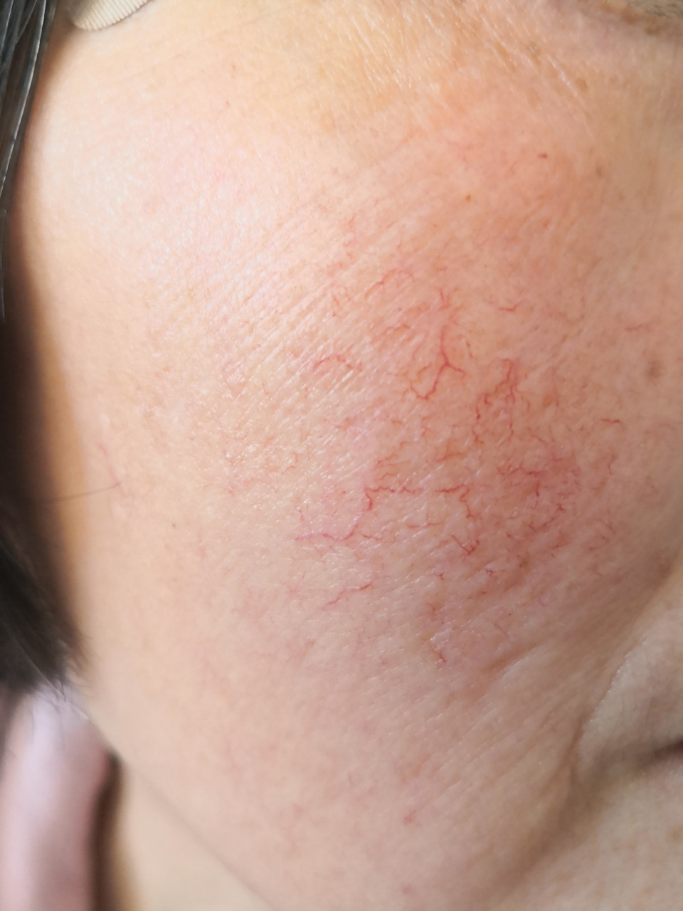 解决皮肤问题专注皮肤美容# 毛细血管扩张症.可以使用激光治疗去除.