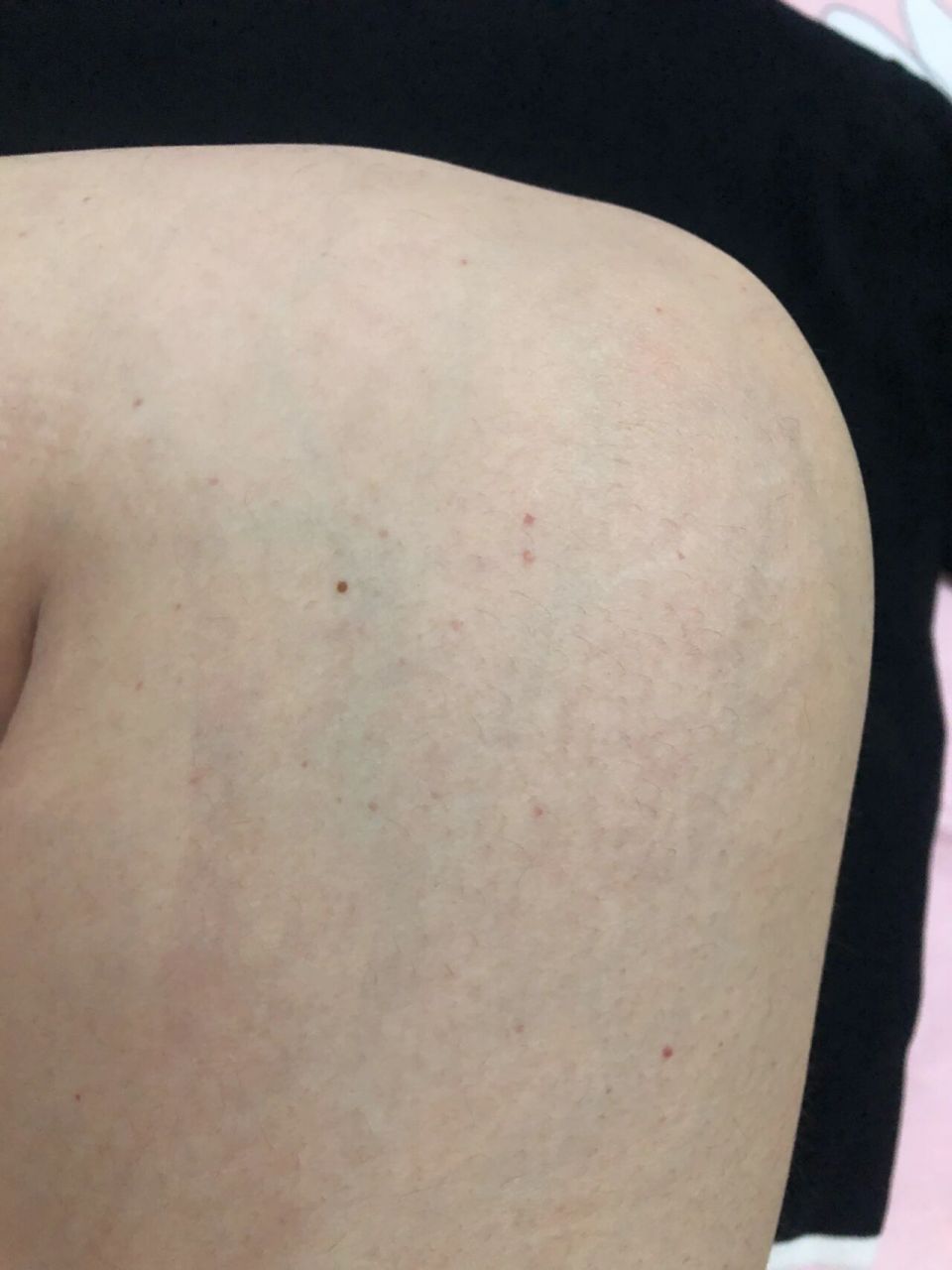 几个月前发现腿上长了好多浅色的痣,淡淡的像斑点,不聚集,但是很多