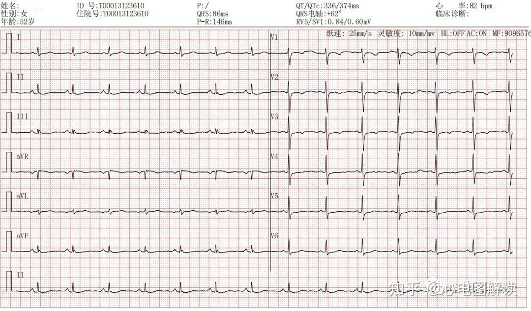 肢体导联低电压