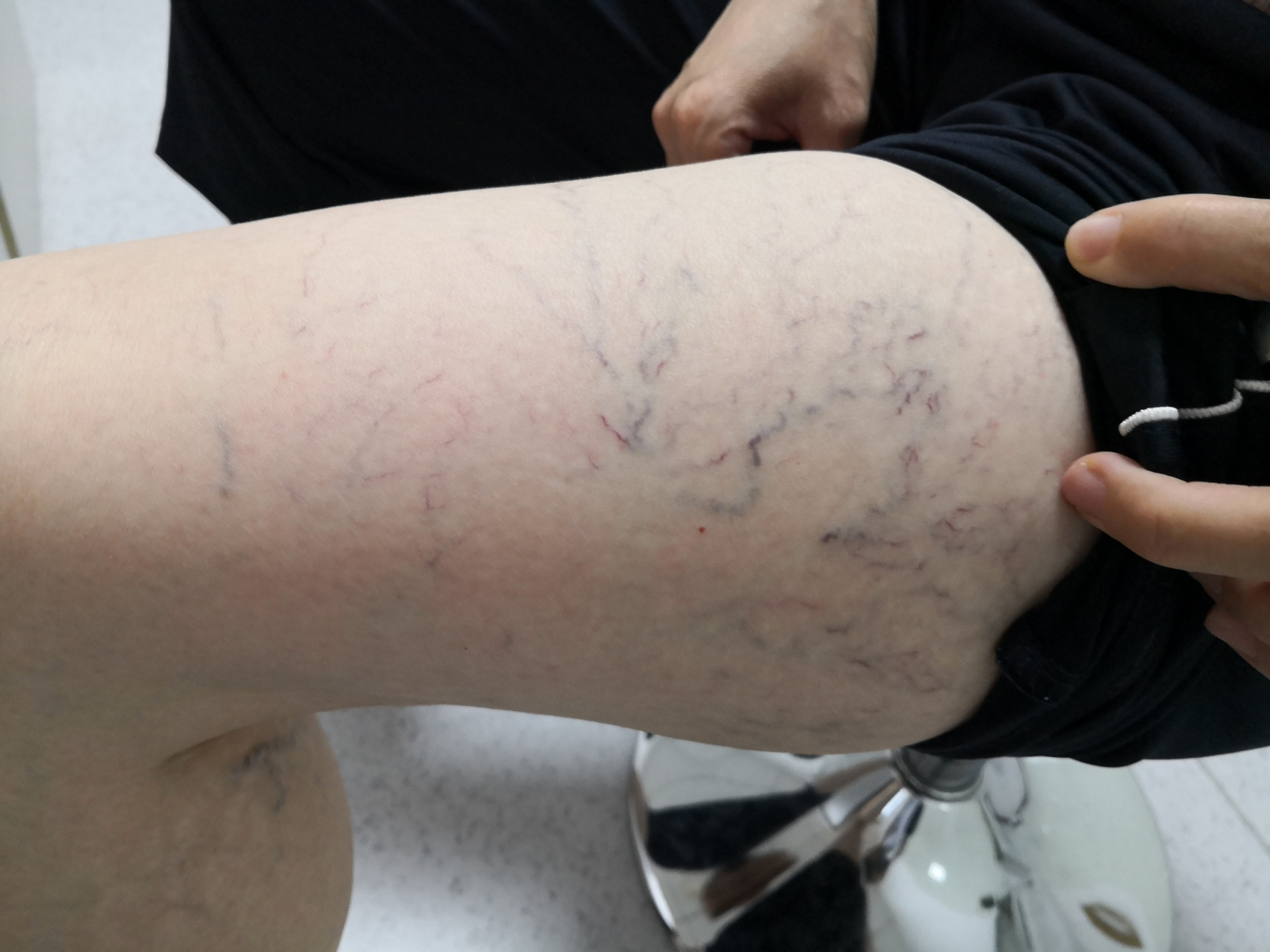 下肢静脉曲张,表浅静脉血管网.