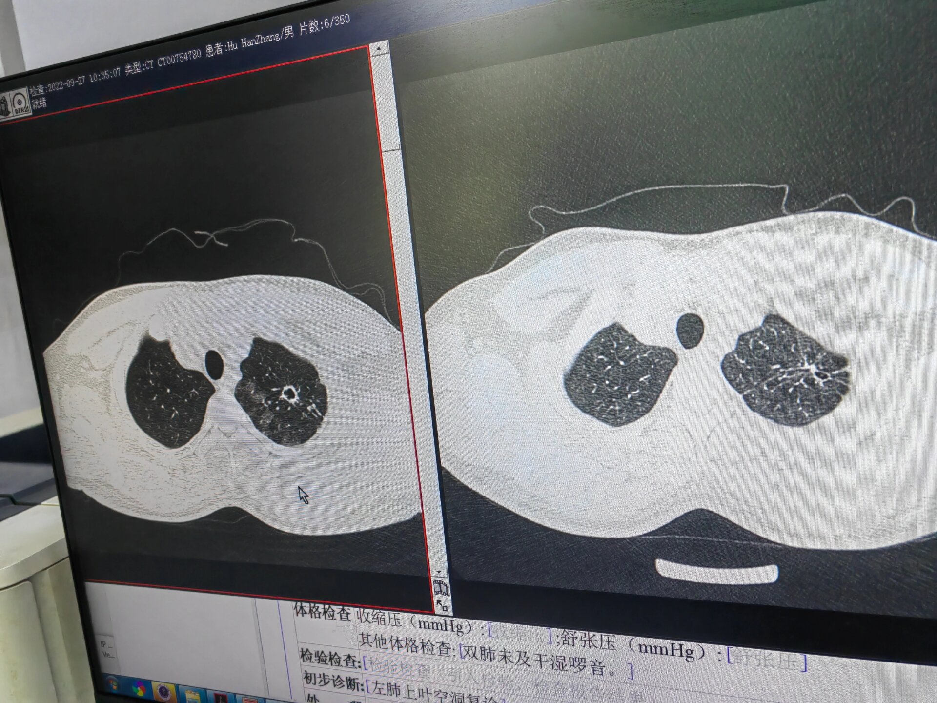 慢性纤维空洞型肺结核图片