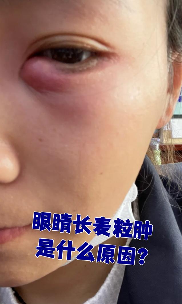 麦粒肿的发生主要和三个原因有关:不良生活习惯,免疫力低下,眼部