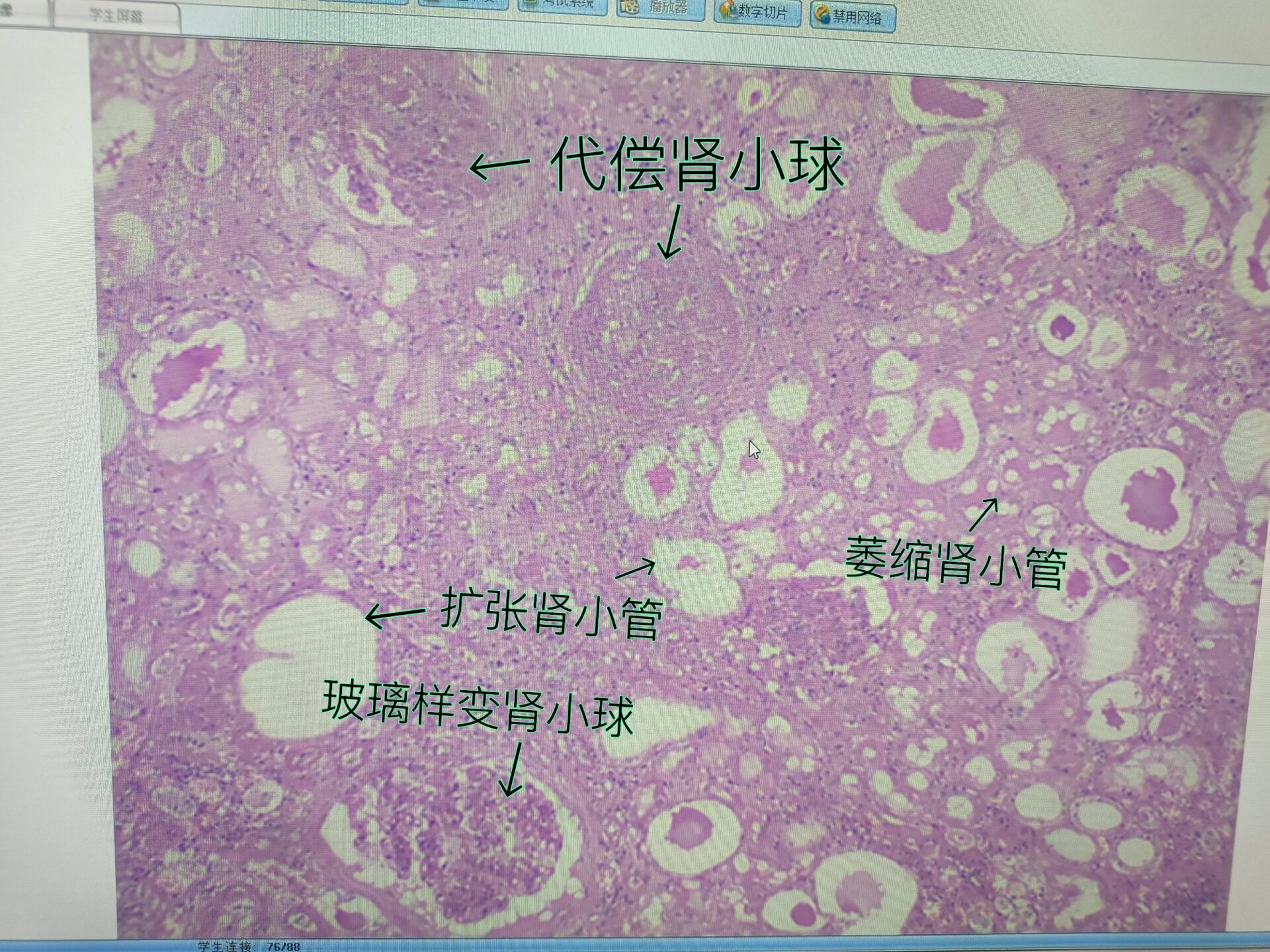 肾浊肿手绘实验报告图图片