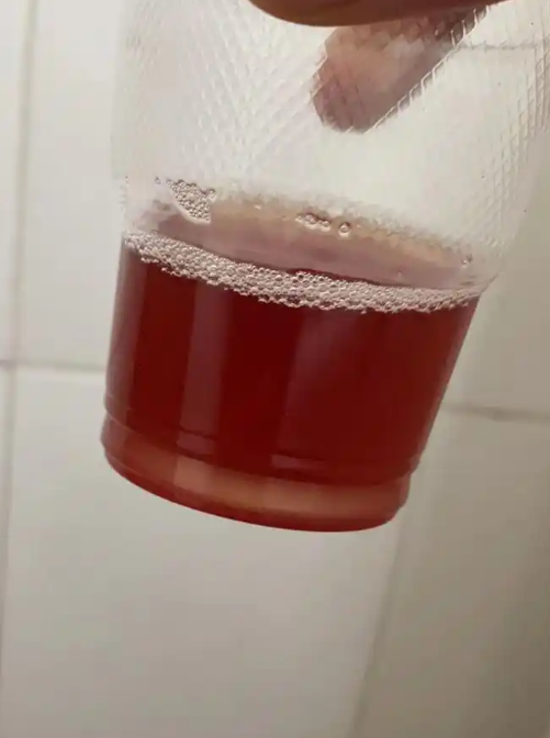 血尿肉眼能看见吗?