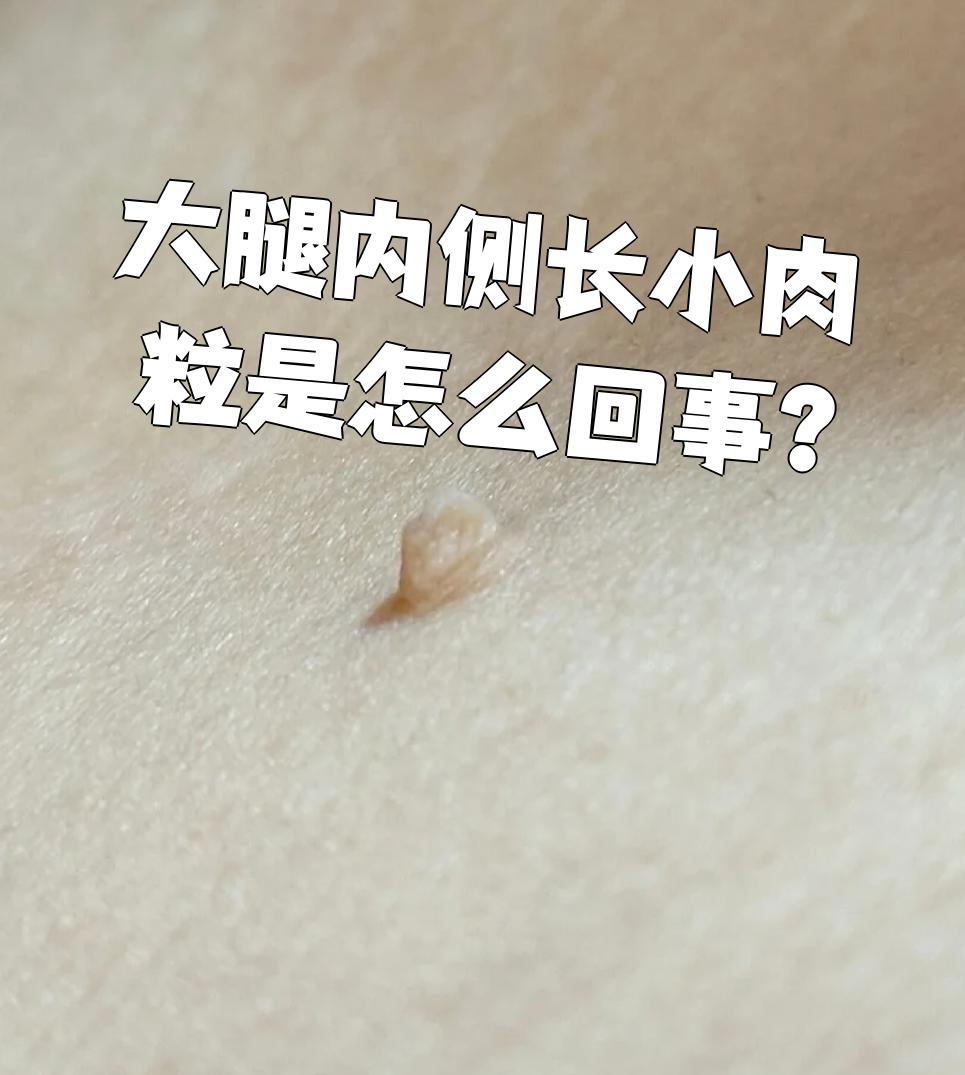大腿内侧长小肉粒,常见的有两种情况:皮赘或者丝状疣