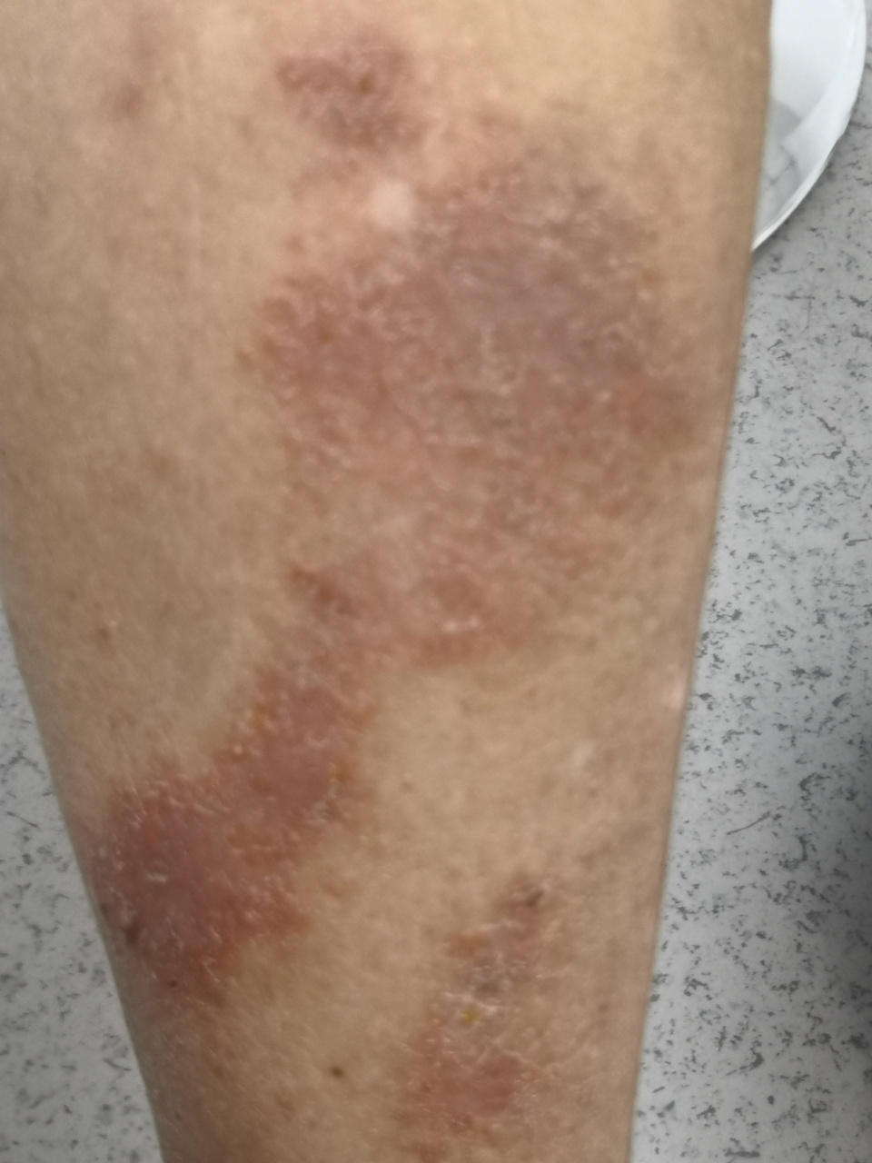 小腿乏脂性湿疹症状.过度清洗会加重症状.#湿疹