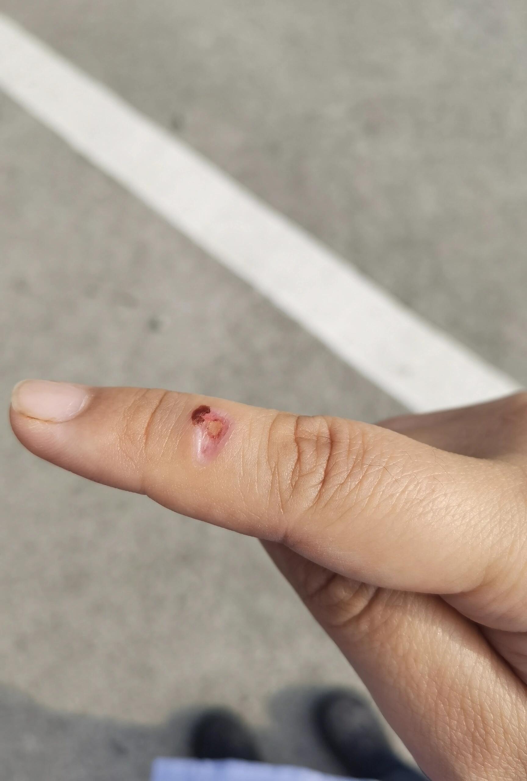 热熔胶烫伤,终于掉痂啦 国庆中秋一起放,休息的第一天想给宝宝做个