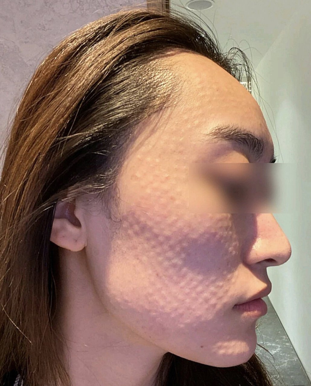 水光针 打完出现皮丘?