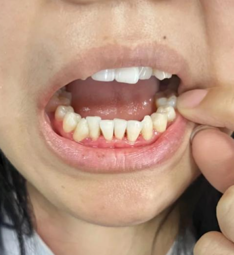 牙凸会随着年龄越来越凸吗?