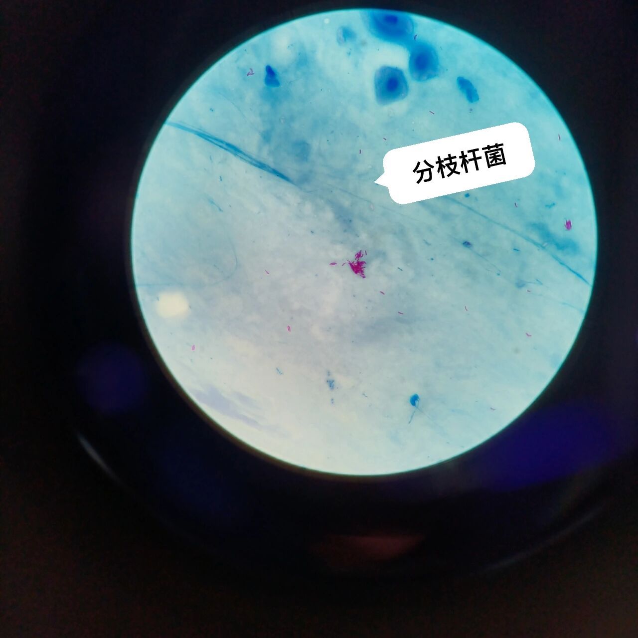结核分枝杆菌抗酸染色