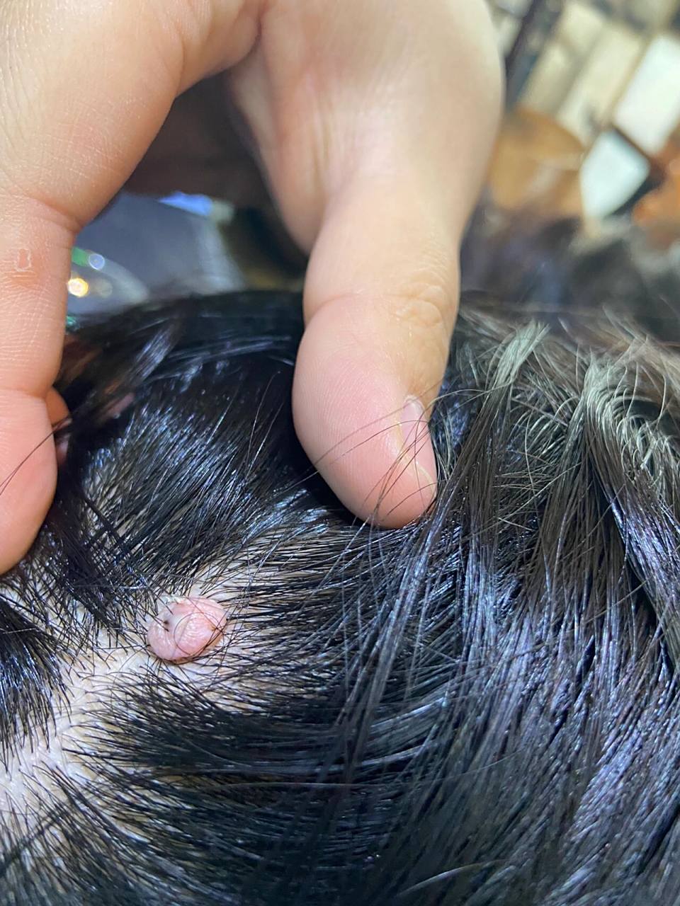 头上长了个肉疙瘩 惊到我了