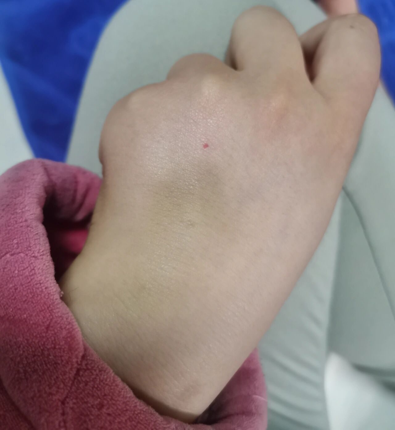 手背突然长了一个小红点 有没有姐妹知道这是什么?
