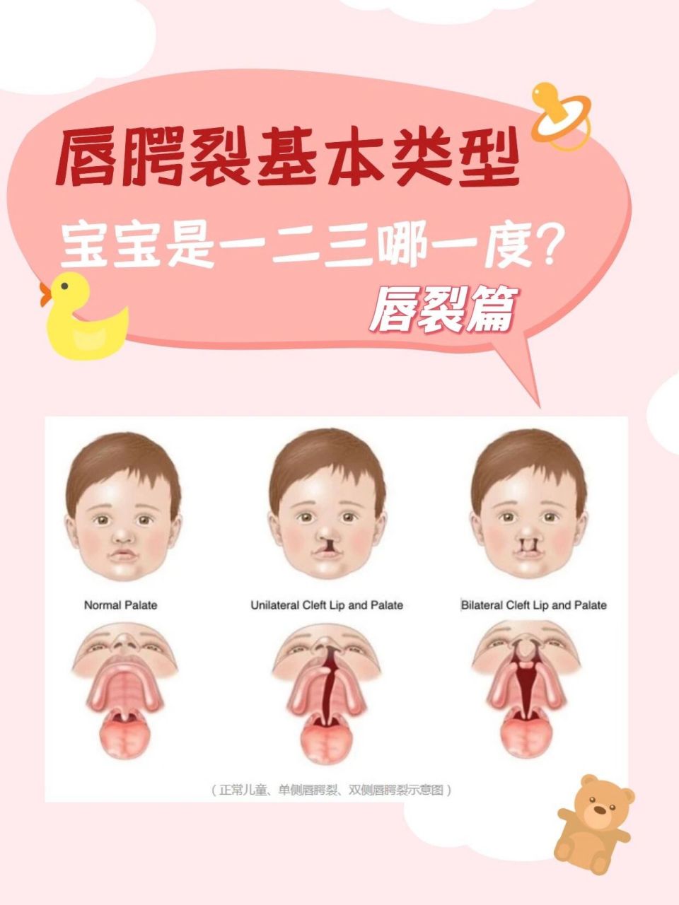 唇裂基本认知:唇腭裂按严重程度分类型 ⭐️单侧唇裂:按严重程度