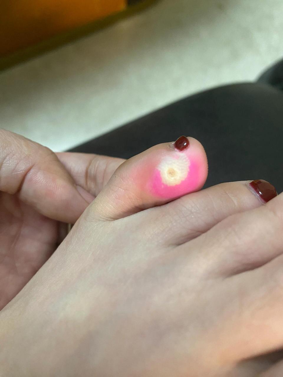 关于鸡眼贴 贴了三天鸡眼贴,周围都变白了 用指甲钳剪了表面一层 还