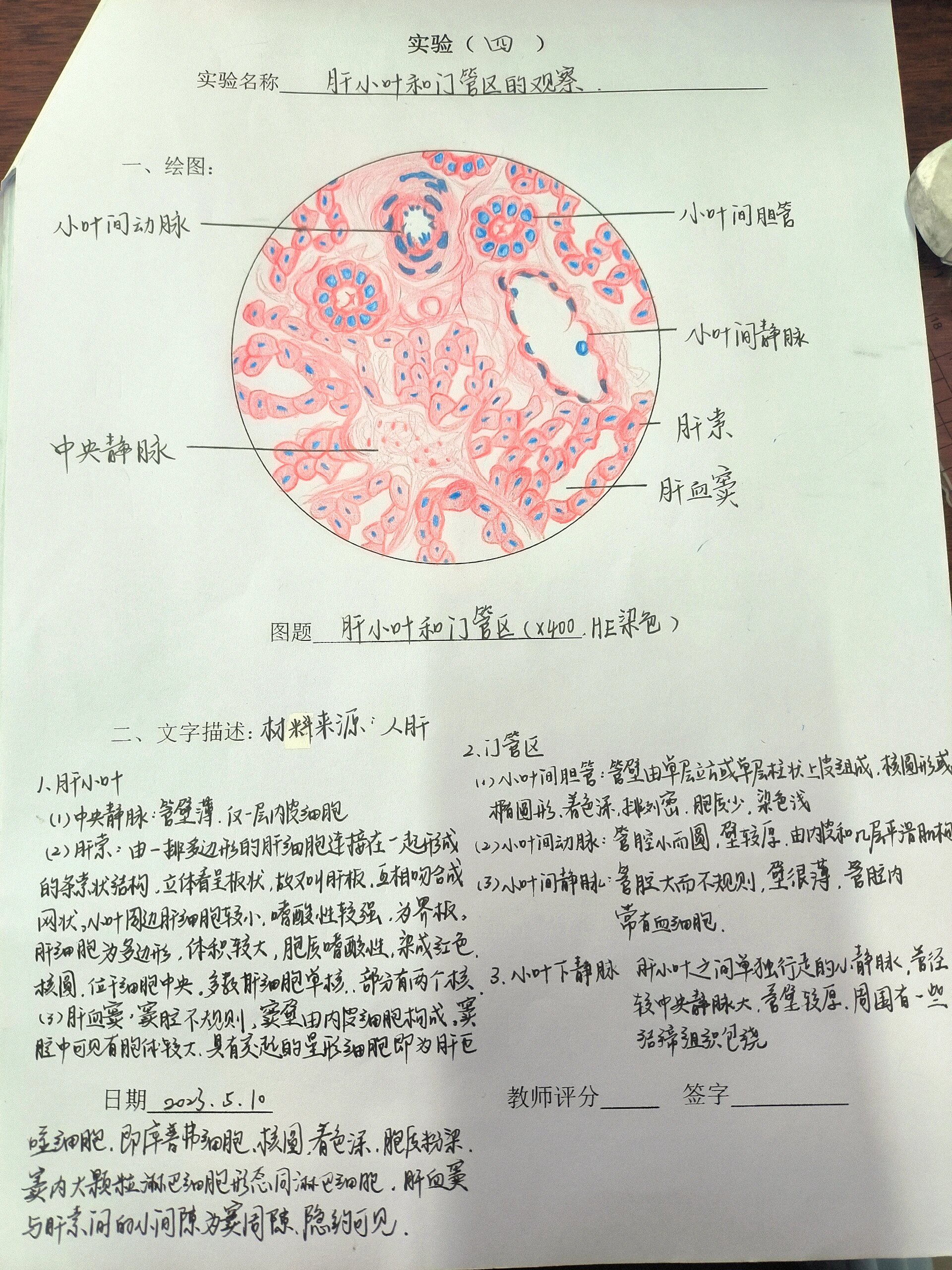 肝硬化假小叶手绘图图片