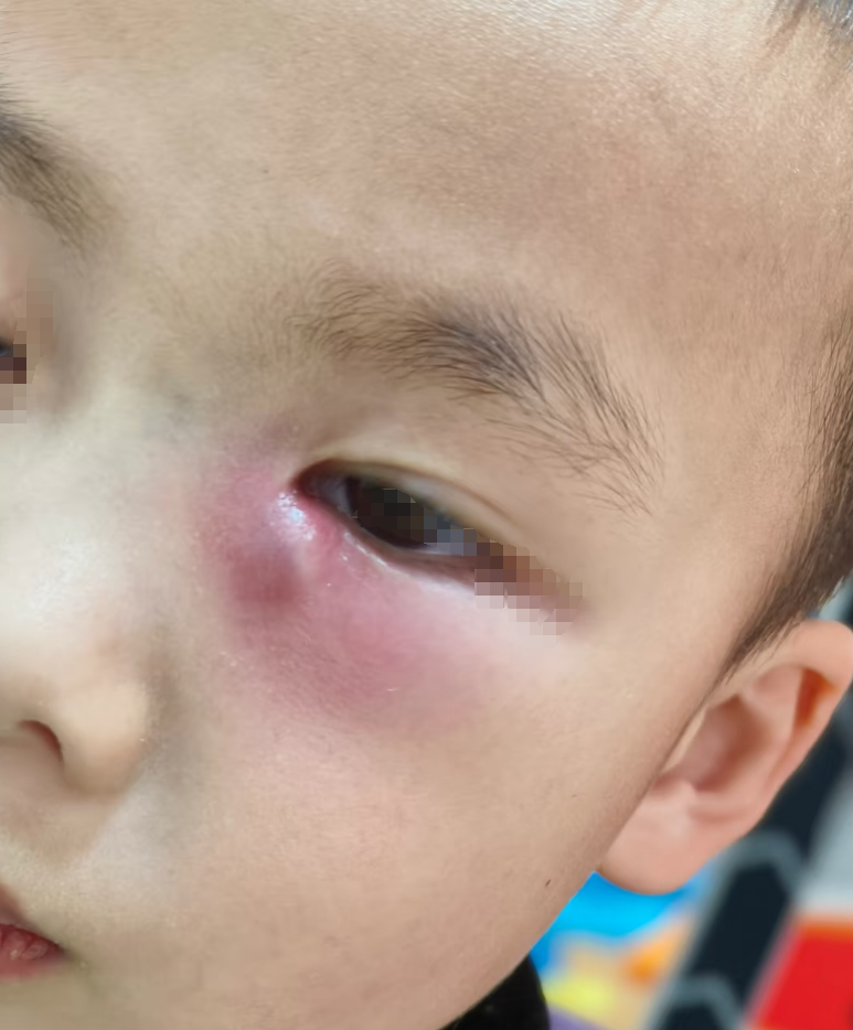 内眼角长白色米粒疙瘩常见原因有这几种: