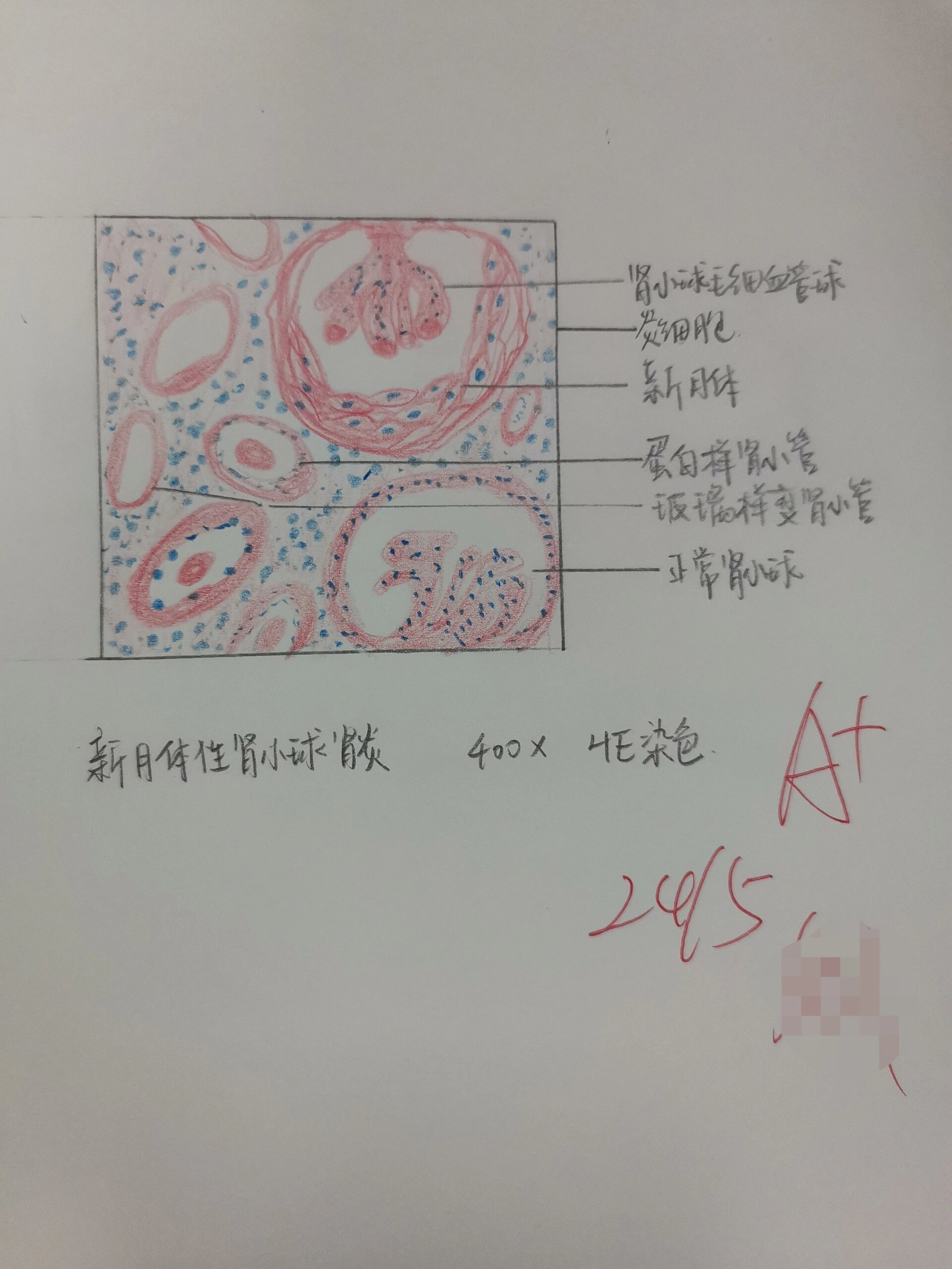 新月体性肾小球肾炎图片