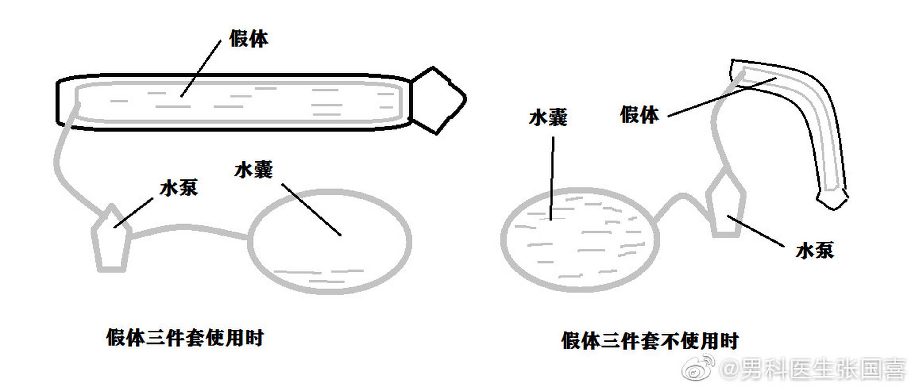 几天前,有一个在国外做了假体植入的羊萎患者私信询问喜叔,为啥他第