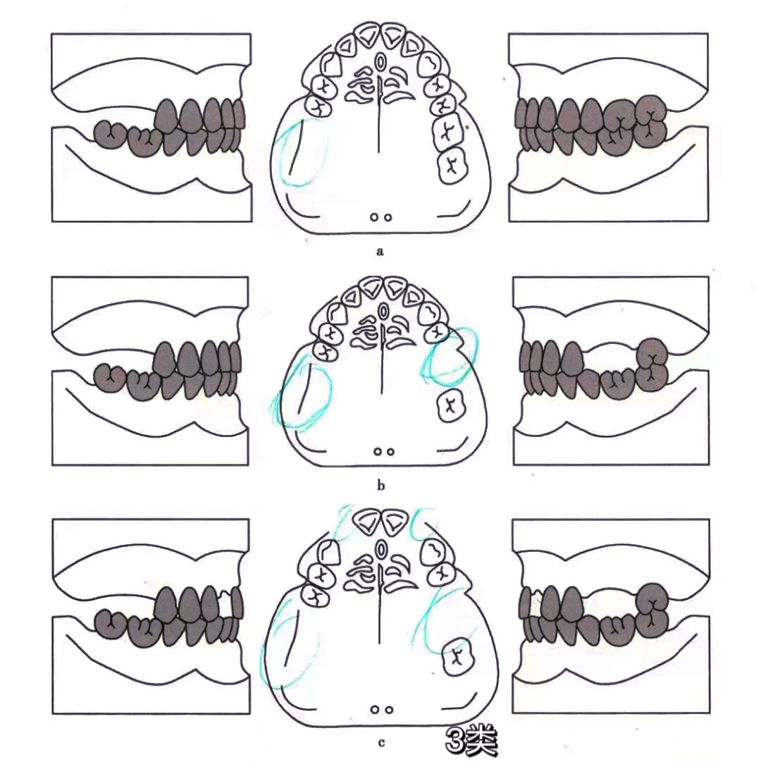 kennedy第一类第2亚类 (注:如此类缺损伴有另外的1个或2个中间缺损