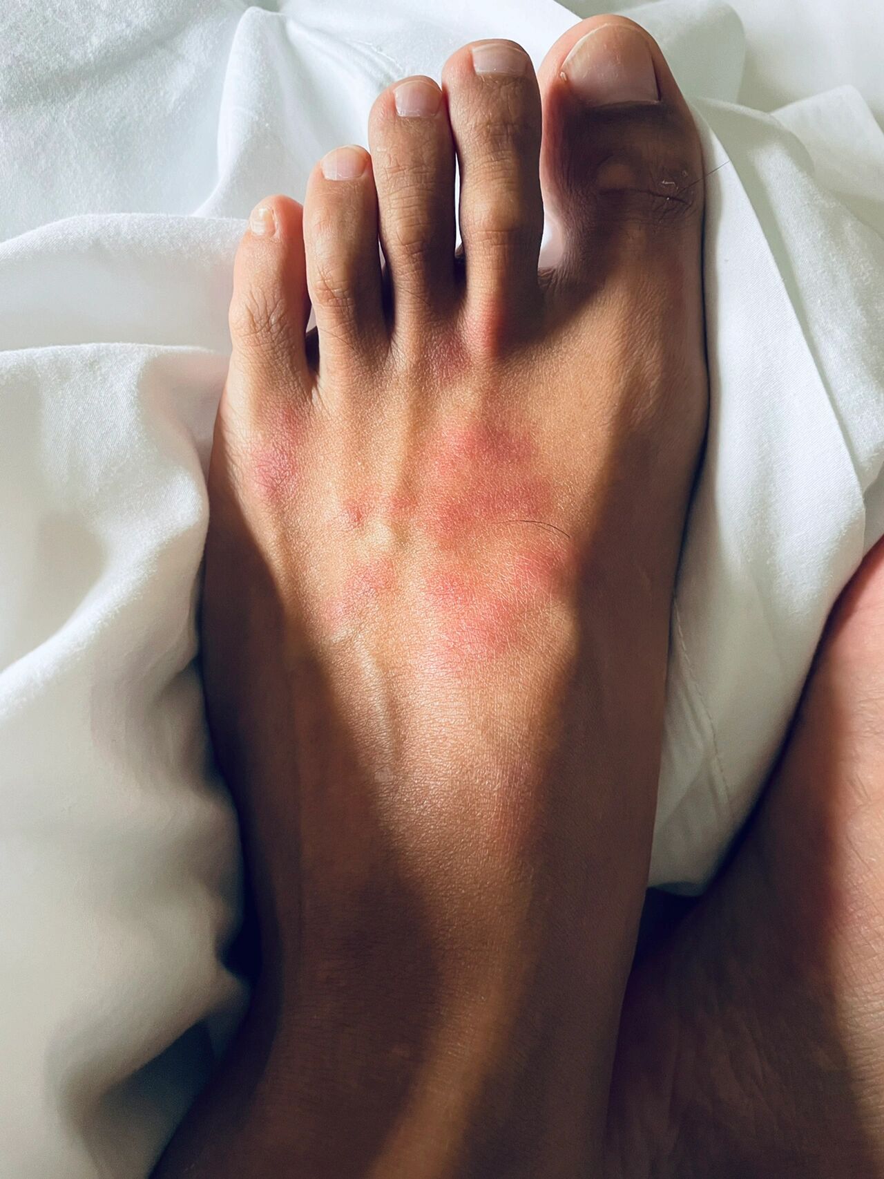 被海蜇咬后的第二天  咬后的第二天一片红疹子 当时在海里,被咬的一