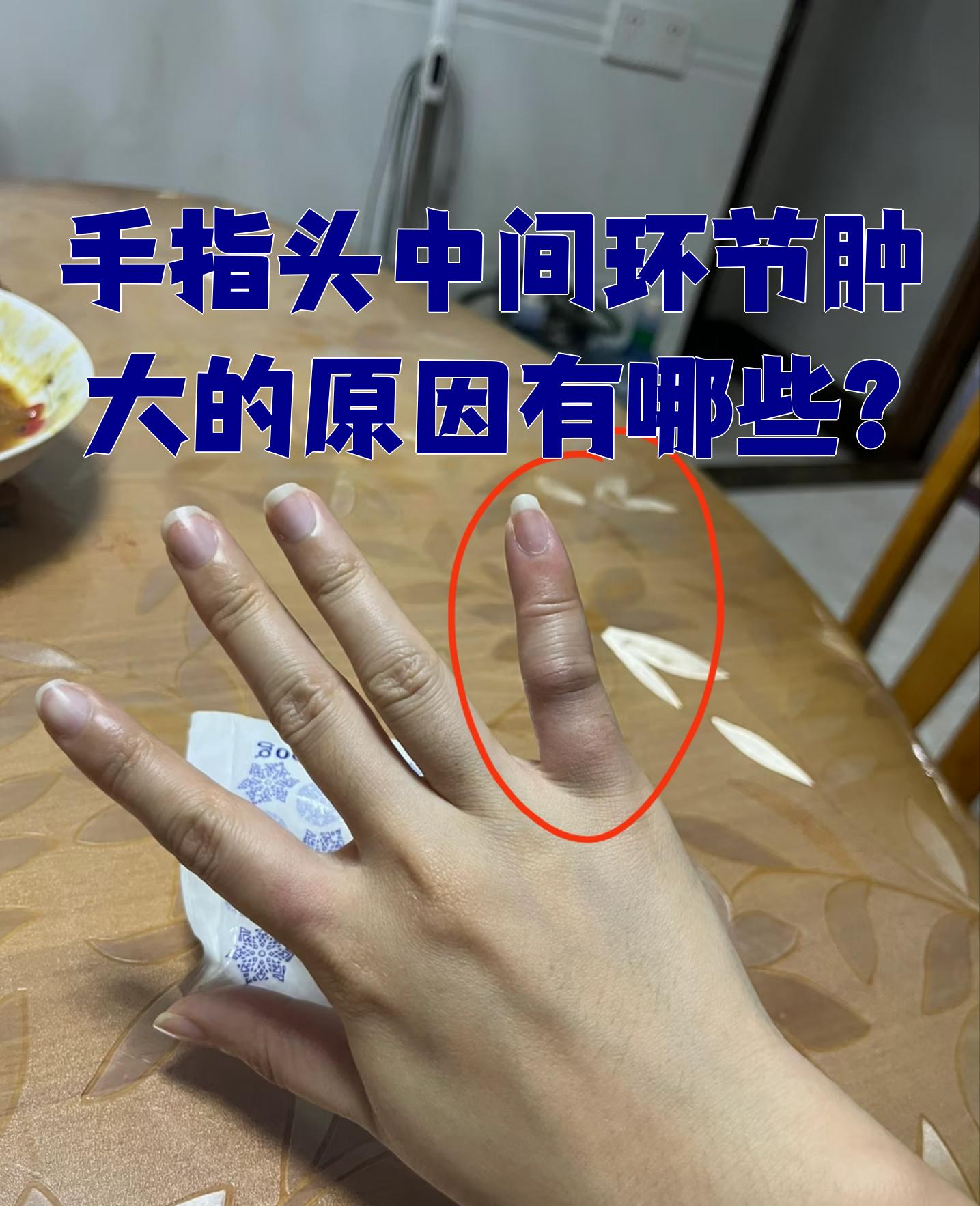 手指中间关节肿大可能由多种原因引起,比如肌肉劳损,外伤,风湿性