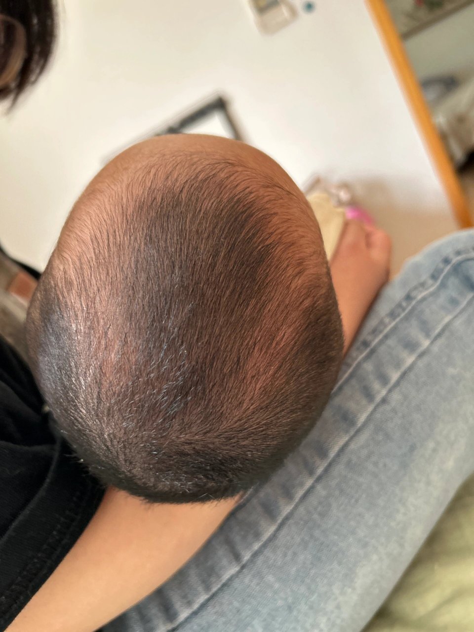 关于婴儿颅顶偏高后脑勺扁平的讨论贴 小红书上看到了很多同款头型