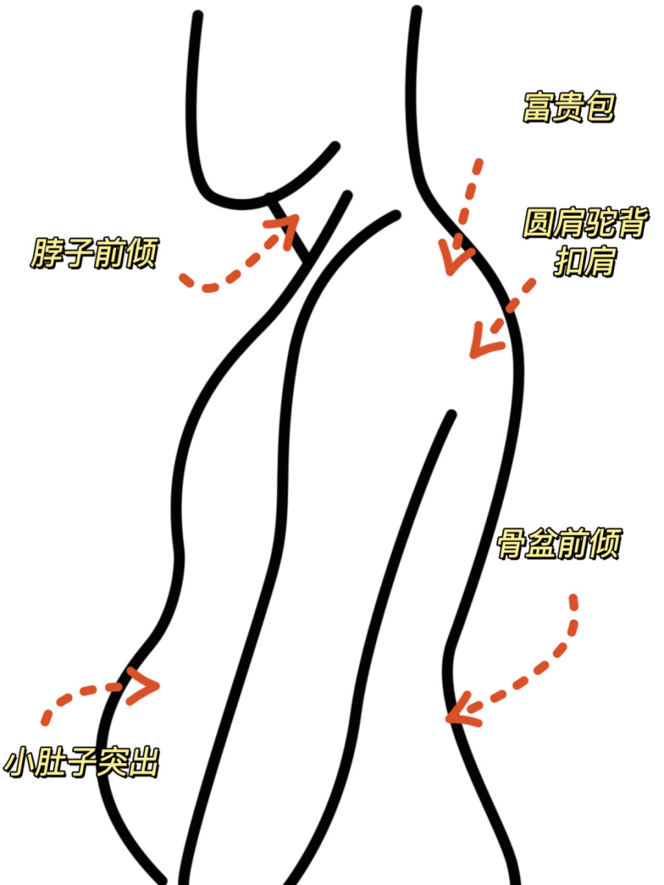 改善体态黄金动作91圆肩驼背99骨盆前倾99 每天36615分钟!