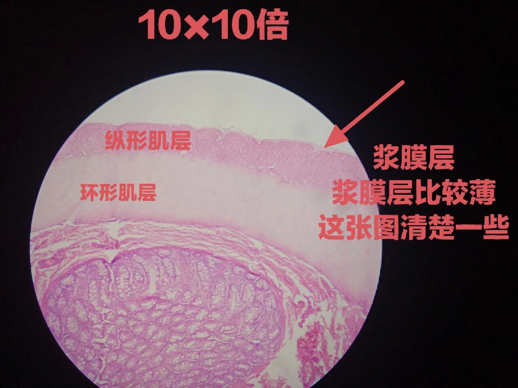 阑尾炎病理生理图图片