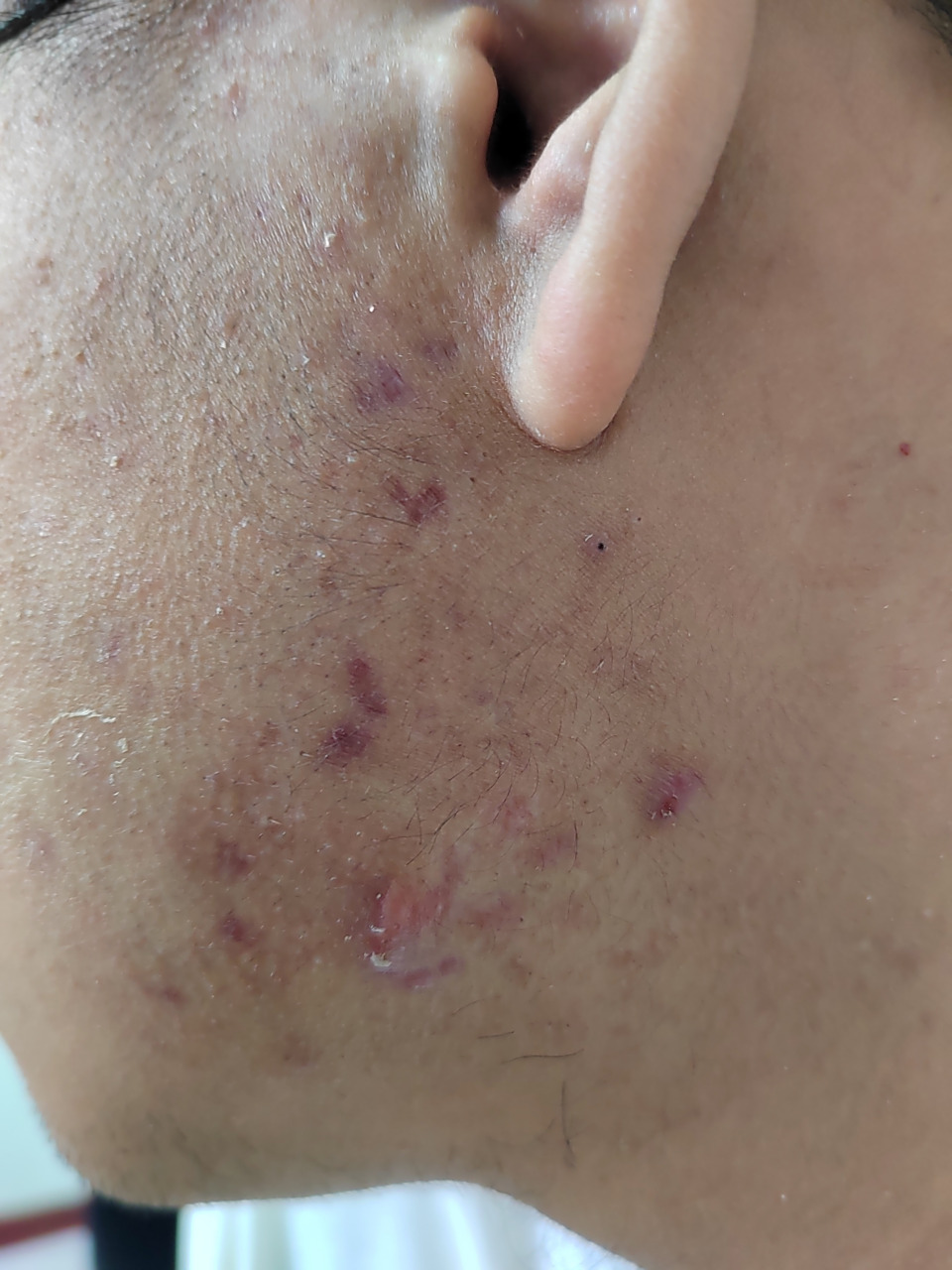 面部痤疮疤痕瘢痕疙瘩.#解决皮肤问题专注皮肤美容##瘢痕疙瘩