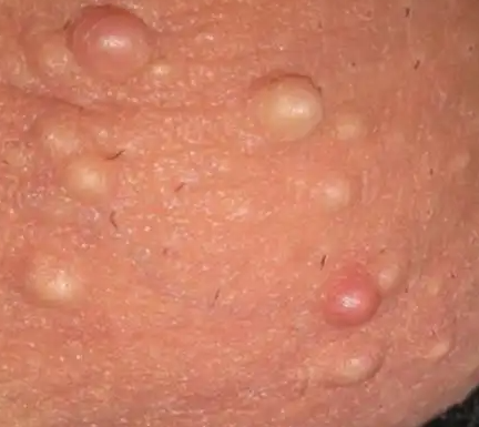 阴囊毛囊一粒粒白色凸起怎么回事怎么办?