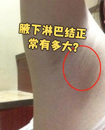 腋下淋巴结正常有多大?