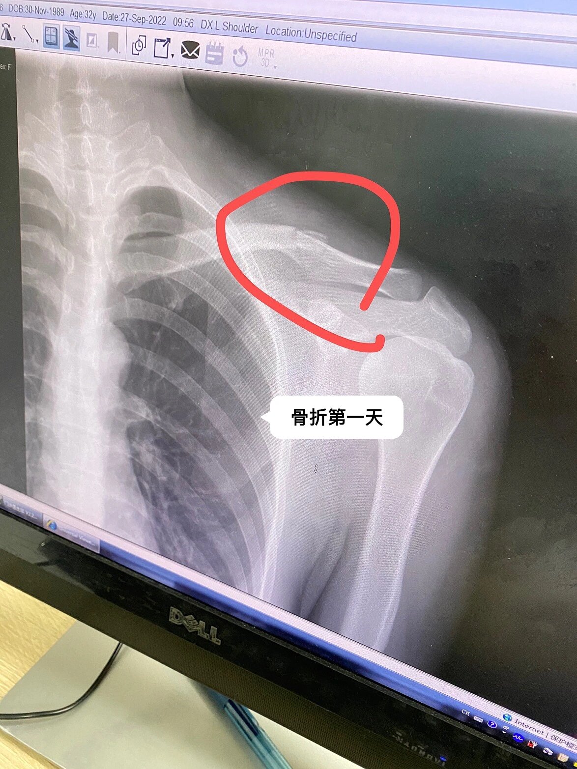 想记录一下锁骨骨折保守治疗