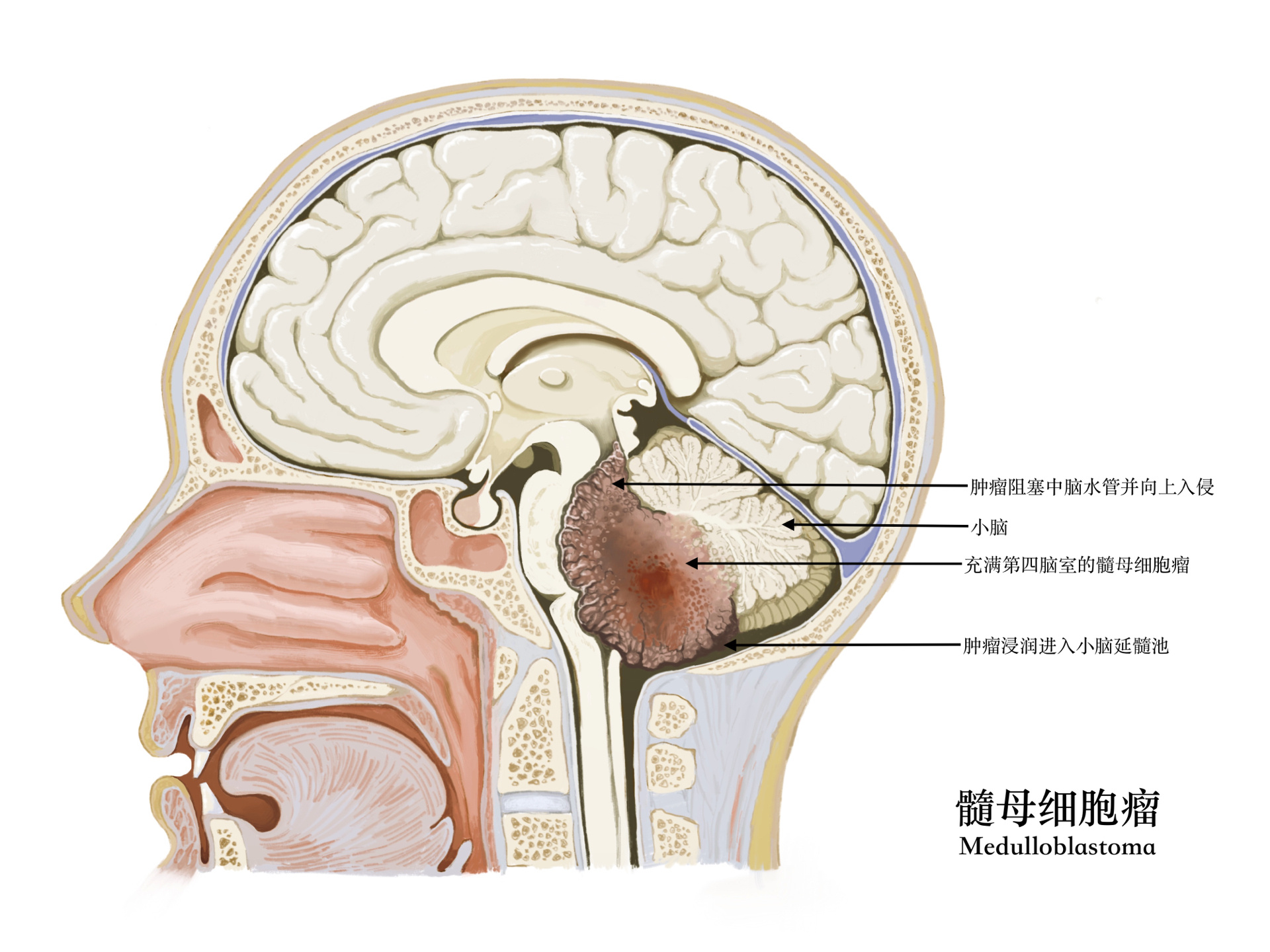 [跟着小爱学病症] day7  髓母细胞瘤 本图以《clinicalkey临床精钥》