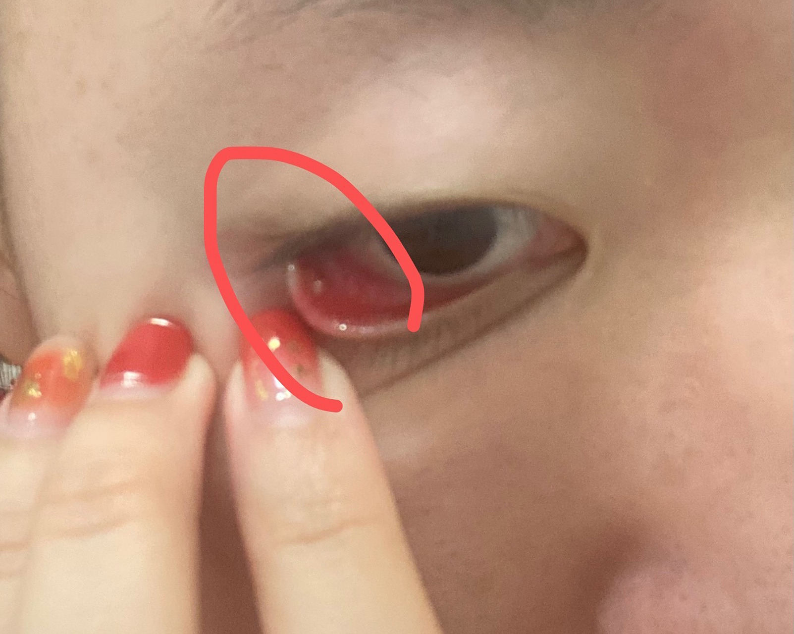 磨得慌,还有点疼,医生说是结石,直接挑了,开了两个眼药水,看看后续