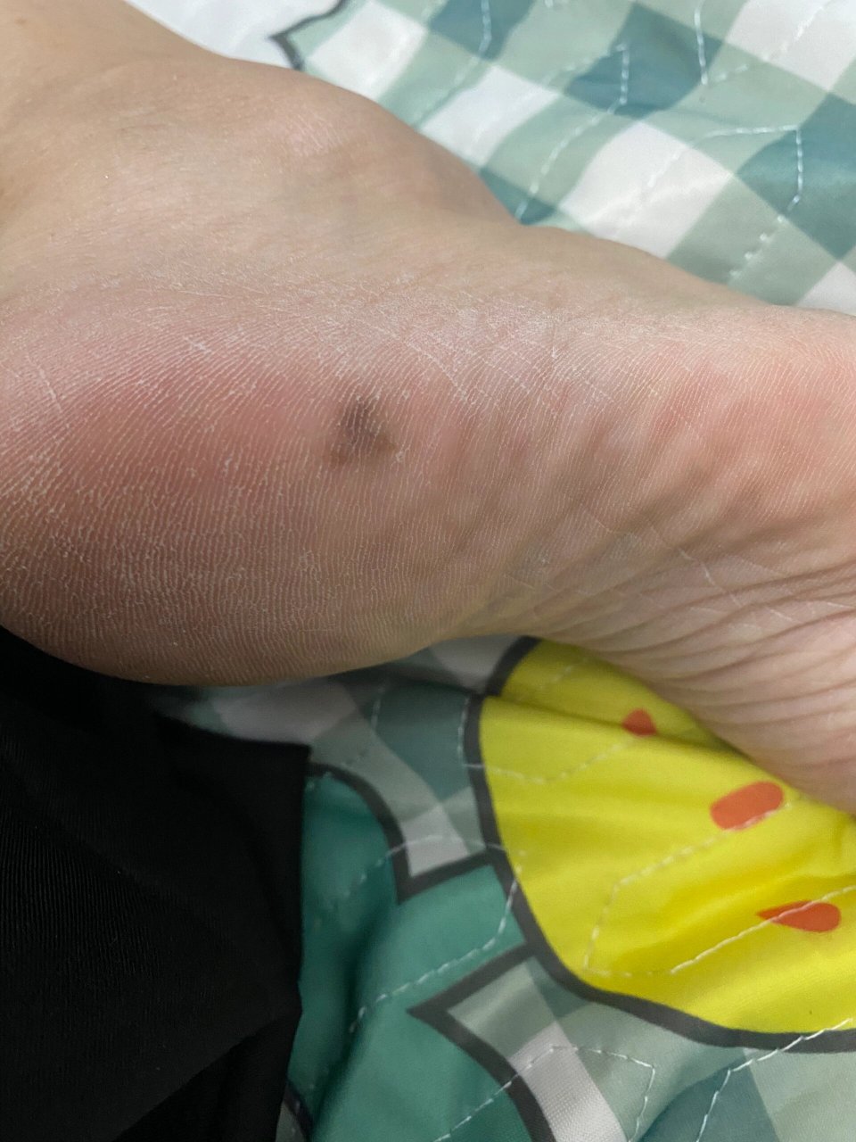 脚底黑色素沉淀需要手术吗 谁和我一样?手术了吗