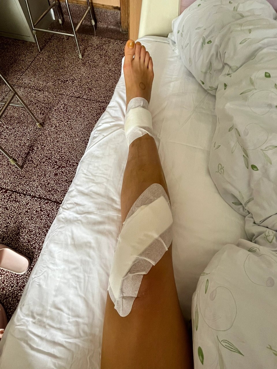 髓内钉拆钉后day2 和其他折友一样,脚踝处的切口往外渗血,说是髓内