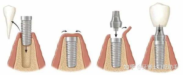 种牙价格如何确定
