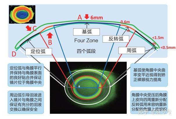 角膜塑形镜偏位范围图图片