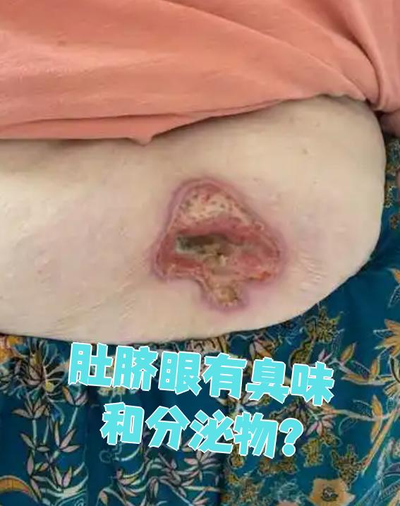 肚脐眼有臭味和分泌物,最常见的原因是细菌感染引起的脐炎