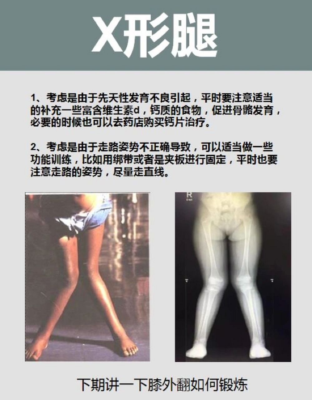 儿童常见x型腿如何矫正