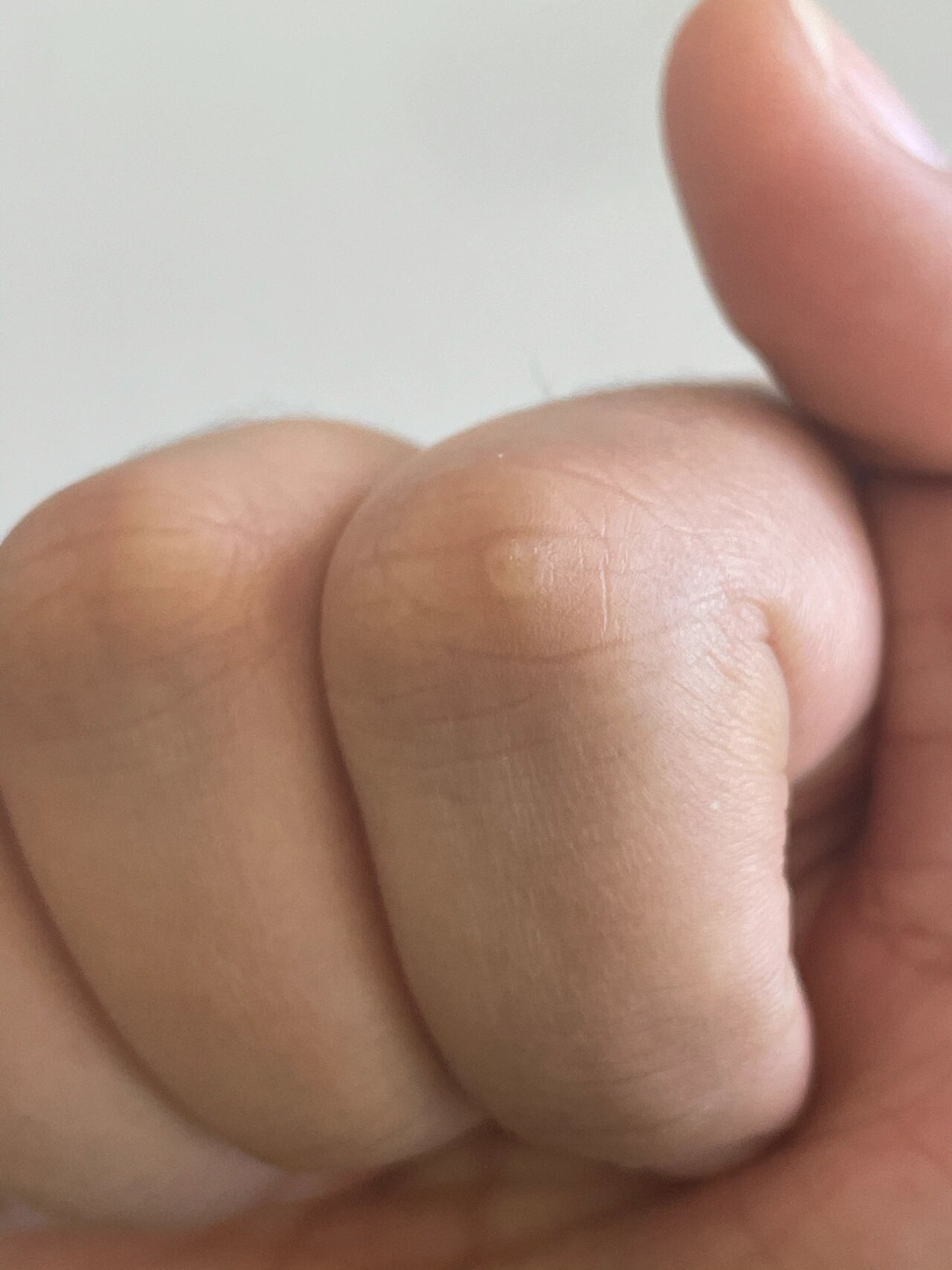 手指关节上长了个半透明的小疙瘩 半透明,比皮肤硬,握拳时和周围皮肤