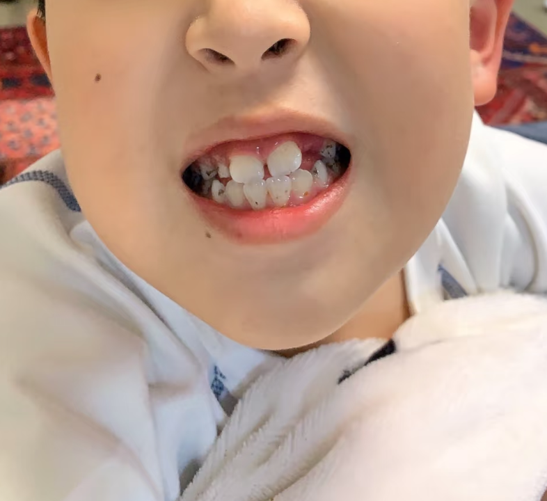 孩子门牙大通常不用太担心,这大多是正常现象