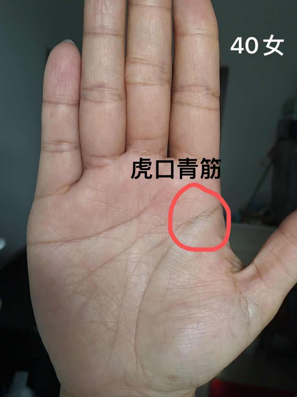 手诊7815乳腺增生的手诊信号 7999观手知健康:虎口处有青筋的