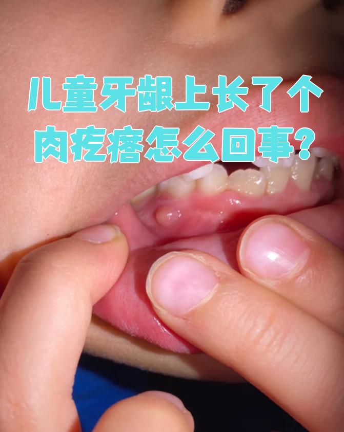 孩子牙龈上长肉疙瘩可能和牙龈脓肿,牙齿萌出,牙龈增生,慢性炎症