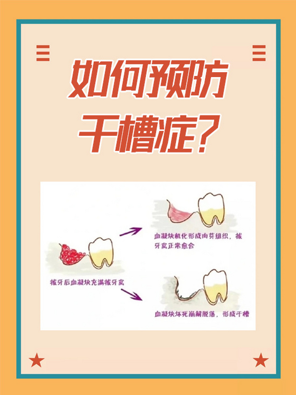 11566做好口腔清洁 拔牙后24小时内不要刷牙,使用牙线或漱口水