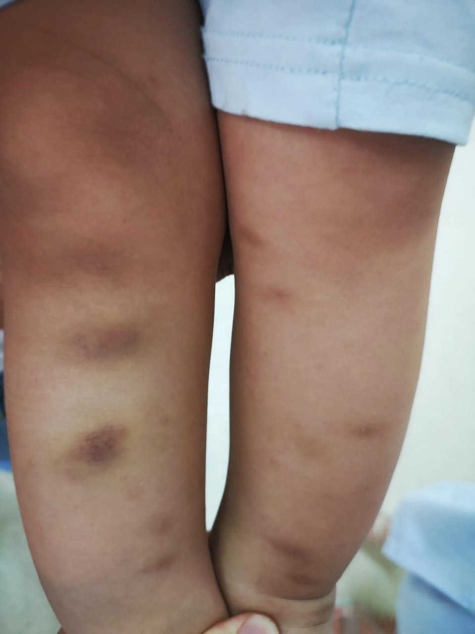 自己五岁的儿子在幼儿园被老师多次捏掐,导致手臂出现淤青,孩子更是