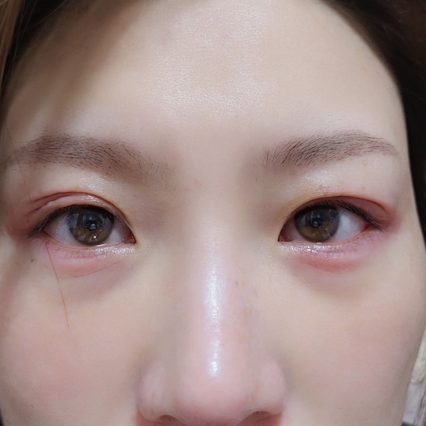 眼皮过敏,又红又肿还痒