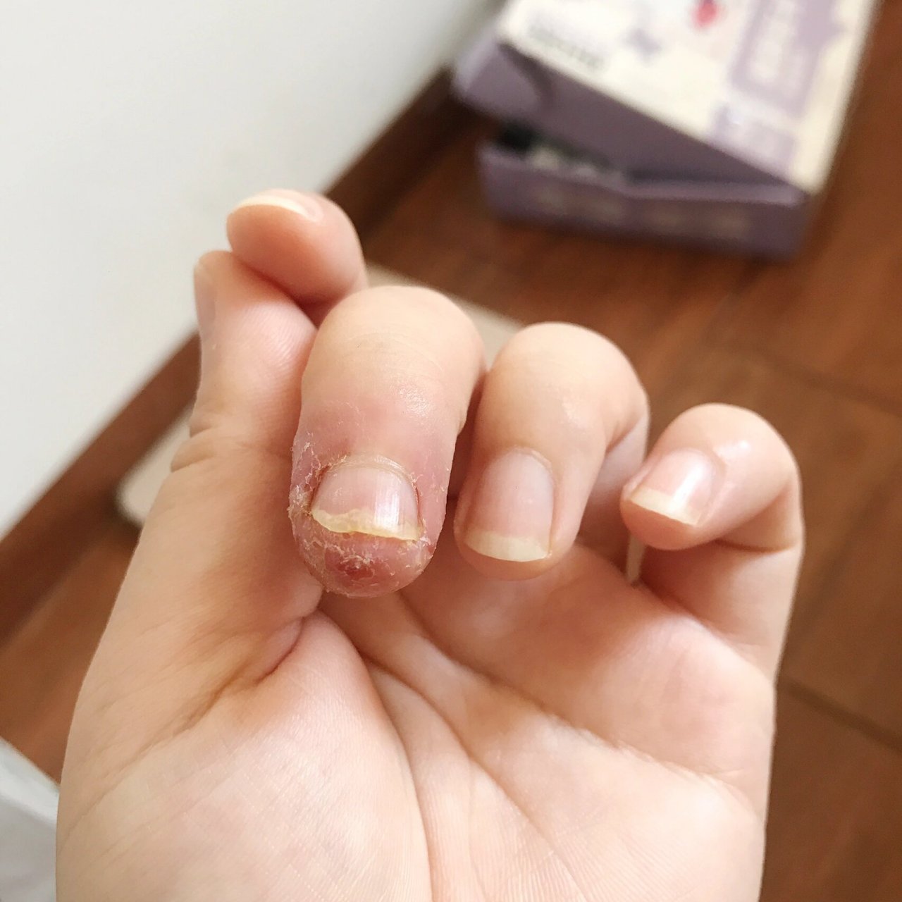 手指真菌感染终于好了 嗯,对于手指真菌感染我还是头一次碰到,刚开始