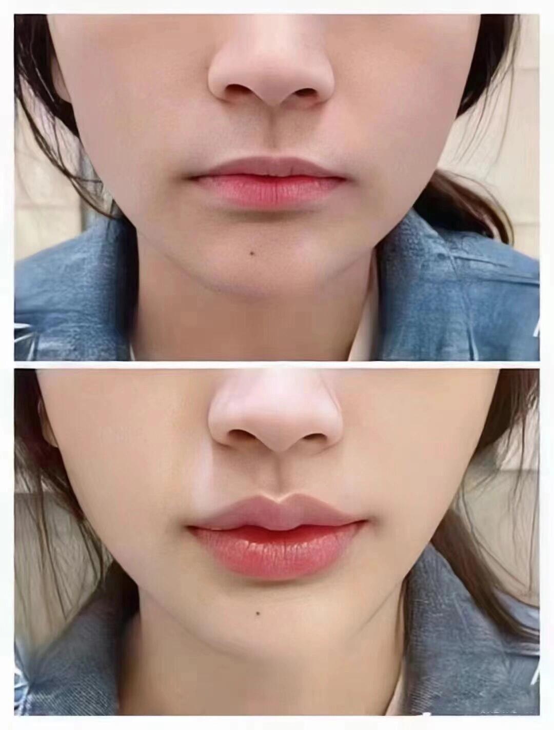 m唇性感甜美m唇,高级又耐看～恢复快,效果显著～ 增加了整张脸的精致